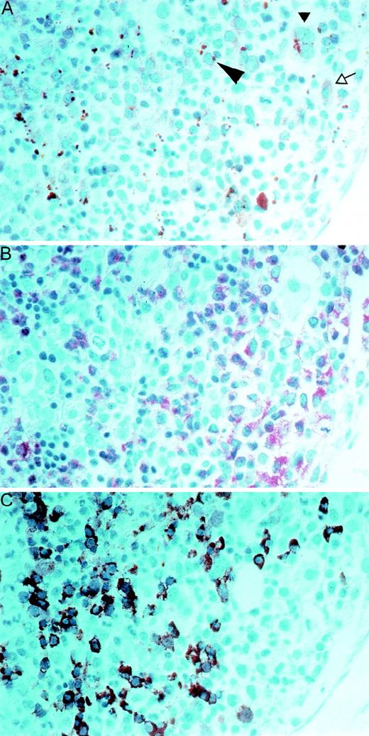Fig. 7. Immunohistochemical staining of paraffin sections of a bone marrow biopsy from a patient with PV. / Serial sections were stained with a polyclonal antibody to native PRV-1 (panel A), to naphthol-AS-D-chloroacetate esterase (NACE, panel B), or with an antibody to hemoglobin (panel C). In panel A, the large arrowhead points to an early erythroblast, the small arrowhead points out a megakaryocyte, and the open arrow shows a promyelocyte. A 1:400 magnification is shown.