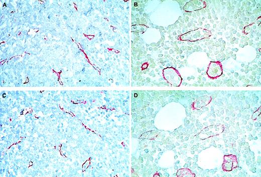 Fig. 1. Immunohistochemical staining of bone marrow sections from patients with acute myeloid leukemia (AML) at presentation (A and C) and control patients (B and D) using antibodies against thrombomodulin (TM) (A and B) and von Willebrand factor (vWF) (C and D). / Note that endothelial cell sprouts and small microvessels without visible lumina were prevailing in AML sections (red staining in A and C), contrasting with big and well-shaped vessels in the controls (B and D). Original magnification ×500.