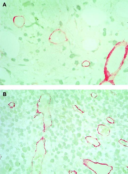 Fig. 6. Immunohistochemical staining of marrows with anti-thrombomodulin (TM) antibodies on day 16 of induction chemotherapy. / (A) Section from a bone marrow without residual blast infiltration. (B) Section from a bone marrow with 10% residual leukemic blast infiltration. Note the bigger size and sinusoidal appearance of the microvessels compared with those on day 0 (Figure 1A and 1C). Original magnification ×500.