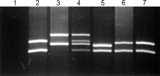 Fig. 1. Amplification of the D1S80 locus in 2 patients (UPNs 322 and 306) electrophoresed in 1.5% agarose gel. / Lines 2 and 5 depict recipient samples before transplantation; lines 3 and 6 depict donor samples. An MC profile is observed in the total white cell fraction at +8 months post-BMT in patient UPN 322 (line 4). A complete donor profile is observed in the follow-up of patient UPN 306 at +20 months post-BMT (line 7). Line 1 depicts water, which is a blank control.