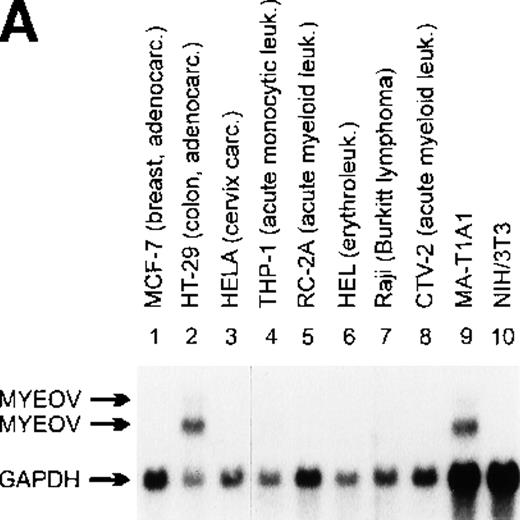 Fig. 1. Northern blot analysis of myeov gene expression in various tumor cell lines of human malignancy, a third-cycle mouse tumor (MA-T1A1) and NIH/3T3 recipient cells. / The purported or actual malignancy of the tumor cell lines are as follows: MCF-7, breast adenocarcinoma; HT-29, colon adenocarcinoma; HeLa, cervical carcinoma; THP-1, acute myeloid leukemia (M5); CCRF-CEM, T-cell acute lymphoblastic leukemia; HEL, acute myeloid leukemia (M6); Raji, Burkitt‘s lymphoma; CTV-2, acute myeloid leukemia (M5); 5637, bladder carcinoma; BT474, breast adenocarcinoma; COLO-206F, colon adenocarcinoma; COLO-680N, esophagus squamous cell carcinoma; A498, renal carcinoma; HEP-3B, hepatocellular carcinoma; A-549, lung adenocarcinoma; COLO-800, melanoma; SK-N-MC, neuroblastoma; MHH-ES-1, Ewing’s sarcoma; COLO-704, ovarian adenocarcinoma. Ten micrograms of total RNA isolated from the indicated cell lines, MA-T1A1 tumor cells (lane 9 in A) and NIH/3T3 cells (lane 10 in A), was submitted to Northern transfer. (A) Filters were hybridized simultaneously with a32P-labeled myeov cDNA insert and a murine glyceraldehyde 3-phosphate dehydrogenase (GAPDH) probe. Bothmyeov transcripts of 2.8 and 3.5 kb and the GAPDH transcript are indicated at the left side. Almost equal amounts of RNA were loaded in each lane as indicated by the GAPDH hybridization. The stronger hybridization of the 2 murine RNAs (MA-T1A1 and NIH/3T3, lanes 9 and 10) can be explained by the weaker hybridization of the murine GAPDH probe to the human homolog. (B) Filters were hybridized with the samemyeov cDNA insert; 28S and 18S ribosomal RNA were used as molecular weight markers. The lower panel shows the ethidium bromide-stained gel as a control for the amount of RNA loaded in each lane.