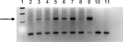 Fig. 1. PCR analysis of a Y-specific sequence in DNA extracted from peripheral blood of female IUT recipients who received at least 1 transfusion from a male donor. / Recipient numbers correspond to recipient numbers in Table 1. Lane 1 shows 100-bp size markers; lane 2 shows DNA from recipient 5; lane 3 shows DNA from recipient 8; lane 4 shows DNA from recipient 6; lane 5 shows DNA from recipient 3; lane 6 shows DNA from recipient 2; lane 7 shows DNA from recipient 7; lane 8 shows DNA from an IUT recipient not tested by the CTLp/HTLp assay; lane 9 shows DNA from a normal male; lane 10 shows a blank; lane 11 shows DNA from a nulligravid woman. The samples in lanes 3 to 9 show a band corresponding to the 237-bp product amplified from Y-chromosome DNA (indicated by the arrow).