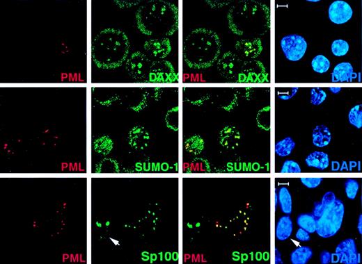 Fig. 2. Transfected PML in PML−/− cells recruits Daxx, SUMO-1, and Sp100 to the NBs. / PML−/− keratinocytes were transfected with pSG5-PML alone or cotransfected with pSG5-PML and pEGFP-Sp100. After 24 hours, cells were harvested and cytospun onto glass slides for immunofluorescence staining. Representative confocal micrographs are shown (PML, red; SUMO-1/Daxx/GFP-SP100, green; DAPI, blue). The yellow color reflects colocalization. The arrow points to a cell transfected with GFP-Sp100 only. This represents the localization pattern of transfected Sp100 in PML−/− keratinocytes where this protein aggregates in large patches. Bar: 5 μm.