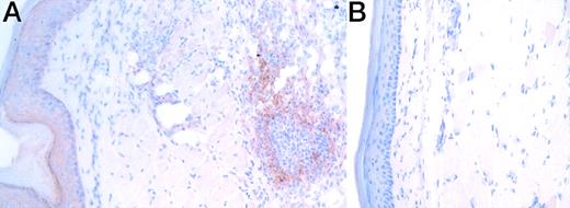 Fig. 1. Immunohistochemical detection of IL-16 in DTH footpads. / The section of mBSA- and PBS-challenged footpads (A and B, respectively) was immunohistochemically analyzed for the expression of IL-16 using anti-IL-16 (17.1) 24 hours after the Ag challenge. No staining was observed when an isotype-matched control mAb (MOPS-21) was used (data not shown). Similar results were obtained in 3 independent experiments.