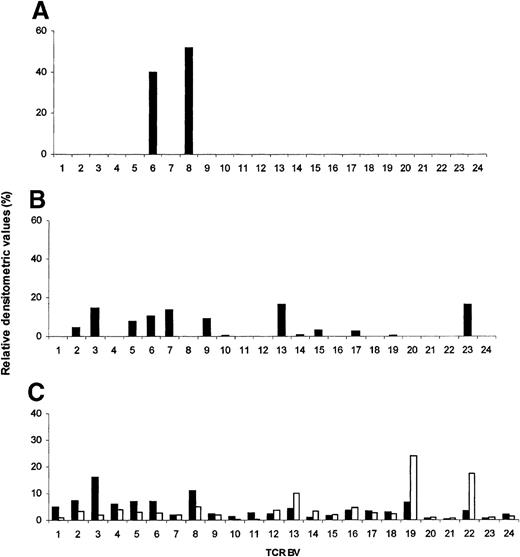 Fig. 6. Analysis of T-cell receptor (TCR) BV repertoire expressed by in vitro–derived p58+ and p58− T-cell lines and ex vivo samples of tumor and peripheral blood mononuclear cells (PBMC). / Comparison of relative expression of TCRBV gene segment in a p58+ TIL cell line (A), a p58− TIL cell line (B), and a tumor fragment (▪) and PBMC (□) (C). For each sample, the spots obtained by Southern blotting of TCRBV gene segments amplified by polymerase chain reaction (30 cycles) were analyzed by densitometry, and each BV signal was expressed as a percentage of the sum of the values of all BV spots.
