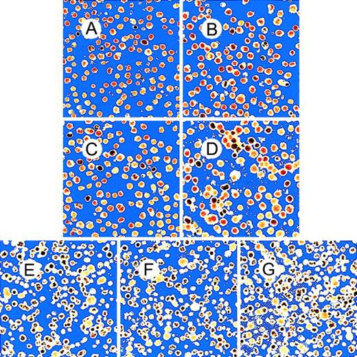 Fig. 4. Confocal fluorescence micrographs of BCBL-1 cells cultured in the absence or presence of anti-NGF antibodies. / Untreated cells were observed at (A) 24 hours, (C) 48 hours, and (E) 72 hours. Cells were treated with 30 μg/mL anti-NGF Ab at 0 hour and observed at (B) 24 hours, (D) 48 hours, and (F) 72 hours. (G) Cells were treated with 30 μg/mL anti-NGF Ab at 0 and 48 hours and observed at 72 hours. To observe nuclei, cells were stained with propidium iodide. Apoptosis was evaluated using morphological parameters such as chromatin condensation and nuclear fragmentation (seen in dense black). (Original magnification ×40.)