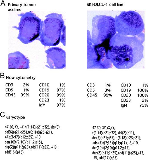 Fig. 1. Characteristics of malignant ascites and resultant SKI-DLCL-1 cell line. / (A) Cells were fixed and stained with May–Grünwald–Giemsa (magnification, ×100). SKI-DLCL-1 cells and cells from the original ascitic fluid demonstrate identical cytologic features consistent with a diagnosis of large-cell lymphoma. (B) Flow cytometric analysis of the ascites and the SKI-DLCL-1 with a panel of monoclonal antibodies. (C) Cytogenetic analysis of the diagnostic ascites and the resultant cell line demonstrates similar though nonidentical findings. This likely represents clonal selection by the process of establishing the cell line.