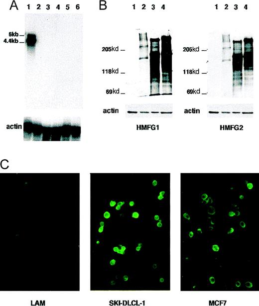 Fig. 8. Expression of the MUC1 gene in SKI-DLCL-1. / (A) Expression of mRNA was evaluated by Northern blot hybridization. One microgram of poly-A+ RNA was electrophoresed on a 1% formaldehyde agarose gel. The blot was hybridized successively with an MUC1 probe and a β-actin probe. Length of exposure on film is 1 hour for both probes. Lanes 1 to 6 represent different cell lines: lane 1, SKI-DLCL-1; lane 2, OCI-Ly8; lane 3, Daudi; lane 4, FL-318; lane 5, Raji; lane 6, Molt-4. (B) Protein expression was evaluated by Western blot hybridization using the MUC1-specific monoclonal antibodies HMFG1 (glycosylation sensitive) and HMFG2 (specific for the repeat motif). Lane 1, Raji; lane 2, MCF-7; lane 3, primary ascites; lane 4, SKI-DLCL-1. (C) Immunofluorescence was used to assess cell-surface expression. Staining of SKI-DLCL-1 cells and MCF-7 cells with HMFG2 antibody demonstrated a strong expression of MUC1. OCI-LY8 cells were used as a negative control in this experiment.