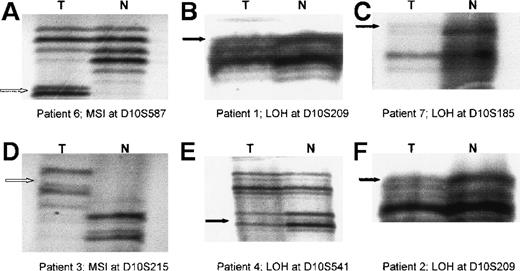 Fig. 2. Radiographs showing loss of heterozygosity (LOH) and microsatellite instability (MSI) in primary cutaneous T-cell lymphoma (CTCL). / Examples are shown of MSI and LOH on 10q detected by using microsatellite markers (D10S587, D10S209, D10S185, D10S215, and D10S541) in tumor samples from 6 patients with CTCL. The black arrow indicates allelic loss (LOH) in tumor (T) DNA with corresponding normal (N) alleles. The white arrow indicates novel alleles (MSI) in T DNA with corresponding N alleles.