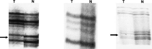 Fig. 3. Radiographs from patient 6 showing homozygous deletion ofPTEN gene. / LOH was found at D10S215 and D10S541, with a 50% to 70% reduction in signal intensity in 1 allele compared with the normal control. The reduction in signal intensity was not 100% because of the presence of normal DNA contaminating the tumor sample. There was retention of heterozygosity at the PTEN intragenic marker D10S2491. This presumably occurred because of loss of both PTEN alleles in the tumor DNA (homozygous deletion) so that only the contaminating normal DNA was amplified to produce 2 alleles with low signal intensity.