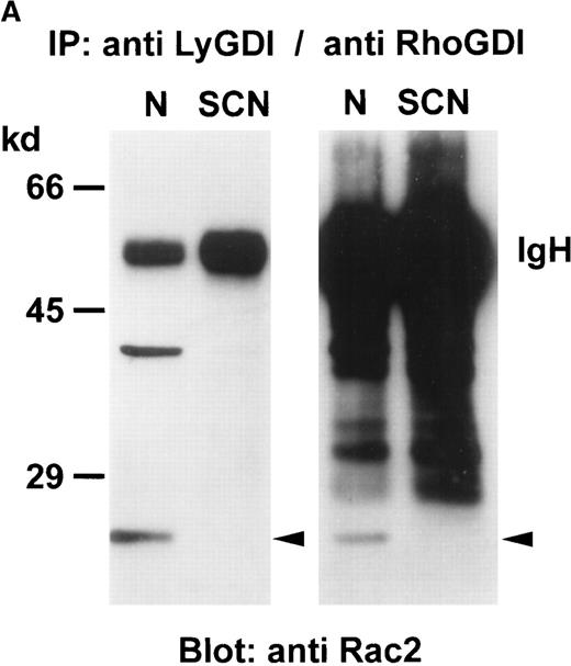 Fig. 4. Association of GTPases and GDIs in neutrophils from healthy individuals and SCN patients. / GDIs were immunoprecipitated from neutrophil cytosol (500 μg protein each), separated on a 8% SDS-PAGE, blotted onto nitrocellulose membranes and detected with (A) anti-Rac2 antibody, (B) anti-RhoA antibody, or (C) anti-LyGDI or anti-RhoGDI antibodies. These results were representative for 3 independent experiments with cells from 3 SCN patients and 3 healthy individuals. N indicates normal neutrophils, and SCN, patients' neutrophils.