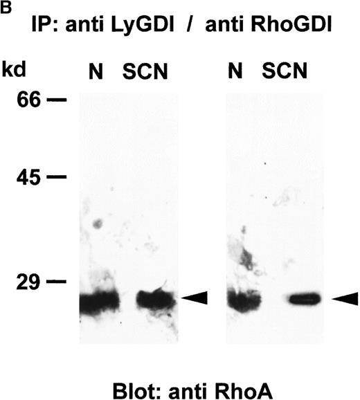 Fig. 4. Association of GTPases and GDIs in neutrophils from healthy individuals and SCN patients. / GDIs were immunoprecipitated from neutrophil cytosol (500 μg protein each), separated on a 8% SDS-PAGE, blotted onto nitrocellulose membranes and detected with (A) anti-Rac2 antibody, (B) anti-RhoA antibody, or (C) anti-LyGDI or anti-RhoGDI antibodies. These results were representative for 3 independent experiments with cells from 3 SCN patients and 3 healthy individuals. N indicates normal neutrophils, and SCN, patients' neutrophils.