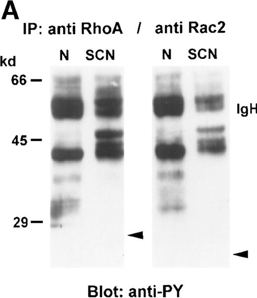 Fig. 6. Tyrosine phosphorylation of GTPases in neutrophils from healthy individuals and SCN patients. / GTPases were immunoprecipitated from neutrophil cytosol (500 μg protein each), separated on a 8% SDS-PAGE, blotted onto nitrocellulose membranes, and detected with (A) anti-PY antibody, or (B) anti-RhoA or anti-Rac2 antibodies. These results were representative for 3 independent experiments with cells from 3 SCN patients and 3 healthy individuals. N indicates normal neutrophils, and SCN, patients' neutrophils.