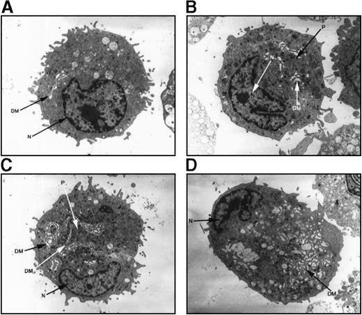 Fig. 7. Ultrastructure of megakaryocytes from a thrombocytopenic family member. / Electron micrographs of 4 characteristic megakaryocytes from 1 affected individual (IV-10) are shown, arranged from least to most differentiated. (A) Very early megakaryocyte with a minimal demarcation membrane (DM) system; the diameter is 11 μm. (B and C) Most common megakaryocytic cells include a more obvious demarcation membrane system and occasional developing platelets (P); the diameters are 12 and 15 μm, respectively. (D) Most fully differentiated megakaryocyte observed with increased demarcation membranes; the maximum diameter is 14 μm. Nuclei (N) are indicated. Magnification, 2900 × for panels A, B, and D; 2300 × for panel C.