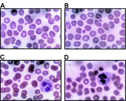 Fig. 2. Platelets from thrombocytopenic individuals. / Peripheral blood smears were prepared immediately upon receipt (within 24 hours of collection) with Wright-Giemsa stain. Representative regions are shown for 3 separate thrombocytopenic individuals (A and B are from IV-10; C from V-14; D from III-10). Panel A includes 1 normal-sized platelet and a red blood cell containing a Howell-Jolly body due to prior splenectomy. Panel B is unusual because 2 platelets can be seen in 1 field. Panel C demonstrates a Döhle body in the cytoplasm of a neutrophil. Panel D includes hypersegmented neutrophils. Both Döhle bodies and hypersegmented neutrophils appear to be common in thrombocytopenic individuals. Magnification, 1000 ×.