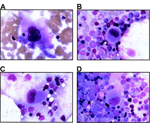 Fig. 3. Bone marrow from thrombocytopenic individuals contains small megakaryocytes with decreased nuclear complexity. / Photomicrographs of bone marrow aspirates are shown after Wright-Giemsa staining (magnification, 750 ×). (A) A representative megakaryocyte from an unaffected individual (IV-8). (B-D) The characteristic morphology of megakaryocytes seen in 2 thrombocytopenic individuals (IV-10 and V-14).