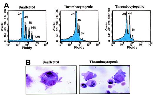 Fig. 5. Abnormal polyploidy formation in thrombocytopenic individuals. / (A) Megakaryocytes from 1 unaffected family member (IV-8) and 2 thrombocytopenic individuals (IV-10 and V-14) were tested for the ability to become polyploid after 10 to 11 days in culture. The cells with highest CD41a expression were selected and plotted as cell number (y-axis; linear scale) versus propidium iodide content (x-axis; logarithmic scale). (B) Photomicrographs demonstrate representative megakaryocytes derived by liquid culture in 10-ng/mL TPO for 7 days (magnification, 1500 ×). At left is a single megakaryocyte from an unaffected individual (IV-8); right, 2 immature megakaryocytes with cytoplasmic blebs around the periphery (IV-10).