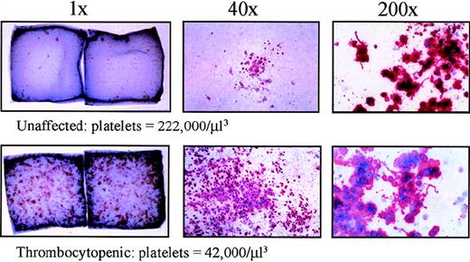 Fig. 6. Increased CFU-Mk in thrombocytopenic individuals. / Megakaryocyte colonies were grown on collagen matrix as described in “Materials and methods.” Cells were fixed and stained for GpIIb/IIIa expression. On the left, double-chamber slides are shown (1 ×, unmagnified) for 1 unaffected (IV-8) and 1 thrombocytopenic individual (IV-10). Dark spots (pink or red) represent individual megakaryocyte colonies; only the larger colonies are visible without magnification. In the center panels, representative megakaryocyte colonies are shown under low-power magnification (40 ×). On the right, higher power views of megakaryocytes (200 ×) demonstrate the presence of proplatelet processes and platelet fragmentation in unaffected and thrombocytopenic samples. Similar data were obtained for a second thrombocytopenic individual (V-14).