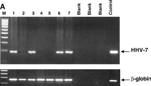 Fig. 5. Nested PCR amplification of DNA extracted from different BM samples to detect HHV-7 genomic sequences. / (A) The results obtained from 7 unfractionated BMMC samples (lanes 1-7). (B) Both CD34+ and CD34− subsets (indicated with + and −, respectively) separated from each BM specimen (samples 8 to 14) have been tested. In panels A and B, the products of either the HHV-7 nested PCR (top gel) or β-globin PCR (bottom gel) are visualized by ethidium bromide staining. Blank lane indicates samples without DNA; lane M, 100-bp ladder of molecular weight marker, lane C, positive control (DNA from HHV-7–infected SupT1 cells), showing the expected amplification products of 142 bp. (C) The degree of CD34 purification (more than 97%) is shown for BM 8. CD34+ cells were double-stained with anti-CD34–FITC and anti-CD3–PE or irrelevant isotype-matched mAb.