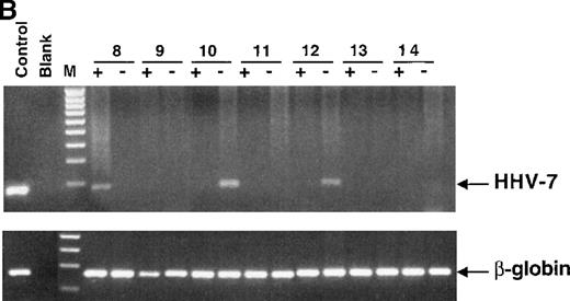 Fig. 5. Nested PCR amplification of DNA extracted from different BM samples to detect HHV-7 genomic sequences. / (A) The results obtained from 7 unfractionated BMMC samples (lanes 1-7). (B) Both CD34+ and CD34− subsets (indicated with + and −, respectively) separated from each BM specimen (samples 8 to 14) have been tested. In panels A and B, the products of either the HHV-7 nested PCR (top gel) or β-globin PCR (bottom gel) are visualized by ethidium bromide staining. Blank lane indicates samples without DNA; lane M, 100-bp ladder of molecular weight marker, lane C, positive control (DNA from HHV-7–infected SupT1 cells), showing the expected amplification products of 142 bp. (C) The degree of CD34 purification (more than 97%) is shown for BM 8. CD34+ cells were double-stained with anti-CD34–FITC and anti-CD3–PE or irrelevant isotype-matched mAb.