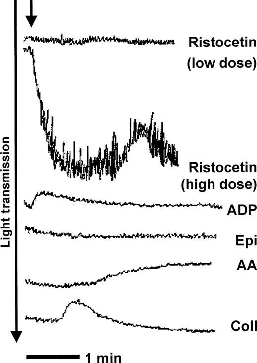 Fig. 1. Platelets from the proband (LD) do not support fibrinogen-dependent platelet aggregation. / Platelet-rich plasma (PRP) from patient LD was stirred in an aggregometer at 37°C before the addition of agonists (time point indicated by arrow). Platelets from LD showed no aggregation in response to adenosine diphosphate (ADP), epinephrine (Epi), or arachidonic acid (AA) and showed shape change only in response to collagen (Coll). Platelets from LD agglutinated reversibly with high-dose ristocetin.