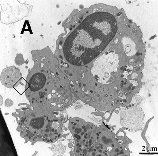 Fig. 1. Collagen-coated glass slides were perfused with native human blood, and the deposited thrombi were double immunostained for TF and CD15. / (A) Electronmicroscopy showing platelets and PMN leukocytes within a thrombus. Note the PMN leukocyte–derived membrane attached to the platelet surface depicted in the boxed field. (B) Closeup examination of the boxed field: the structure double stains for CD15 (10-nm gold grains) and TF (5-nm gold grains). (C) TF on small particle-like structures in proximity to PMN leukocytes.