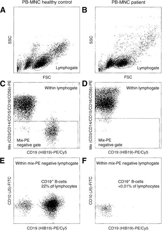 Fig. 1. Sensitive flow cytometric analysis of PBMC of a healthy control and the patient with the 631delT RAG1 gene. / Based on scatter characteristics, gating was performed on lymphocytes (A and B). To further reduce background staining in our attempts to detect rare events (CD19+ B cells), we used a so-called exclusion gate with negativity for labeling with the PE-conjugated CD3, CD14, CD15, CD16, and CD56 antibodies (C and D). This exclusion of T-lymphocytes, monocytes, granulocytes, and NK cells resulted in the sensitive detection of CD19+ B-lymphocytes. The patient had less than 0.01% CD19+ B-lymphocytes (F); the healthy control had 22% (E).