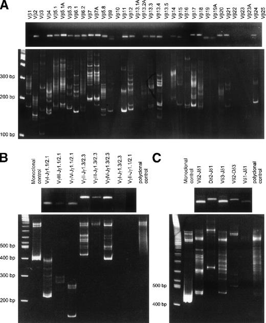 Fig. 2. Agarose gel and heteroduplex PCR analysis ofTCR gene rearrangements. / TCRB gene rearrangements (RT-PCR with Vβ-Cβ primer) (A), TCRG gene rearrangements (B), and TCRD gene rearrangements (C) showing oligoclonal rearrangement patterns in an otherwise polyclonal background. The upper part of each panel shows the presence of PCR products in agarose gels for virtually each primer combination, whereas the lower part of each panel shows heteroduplex analysis of the obtained PCR products. The oligoclonal patterns are probably related to the high T-cell counts with expansion of several T-lymphocyte clones.
