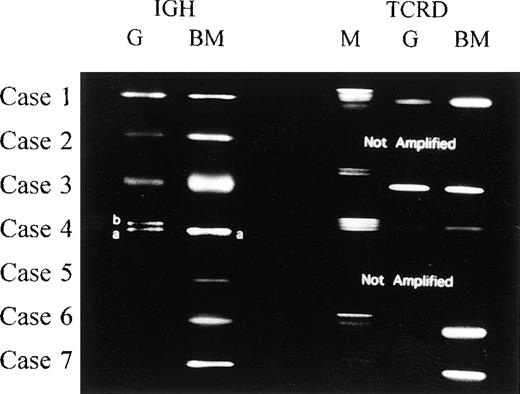 Fig. 2. PCR analysis for rearranged IGH and TCRD. / Amplification of rearranged IGH and TCRD from 7 cases in our study. Comparison of the PCR products from cases 1, 2, and 3 showed no size differences between Guthrie card and leukemic cell DNAs representing the IGH. We could not detect the rearranged TCRD from leukemic cell DNA and corresponding Guthrie card DNA in case 2. For case 4, the rearranged IGH product from Guthrie card DNA consisted of 2 different-sized fragments (4a and 4b), 1 of which (4a) was identical to the fragment amplified from leukemic cell DNA. Sequencing of the (a) and (b) DNAs revealed the same V-D-J or V-D rearrangements (Tables 3and 4). M indicates DNA size marker; G, PCR products from Guthrie card DNA; and BM, PCR products from leukemic bone marrow cell DNA.