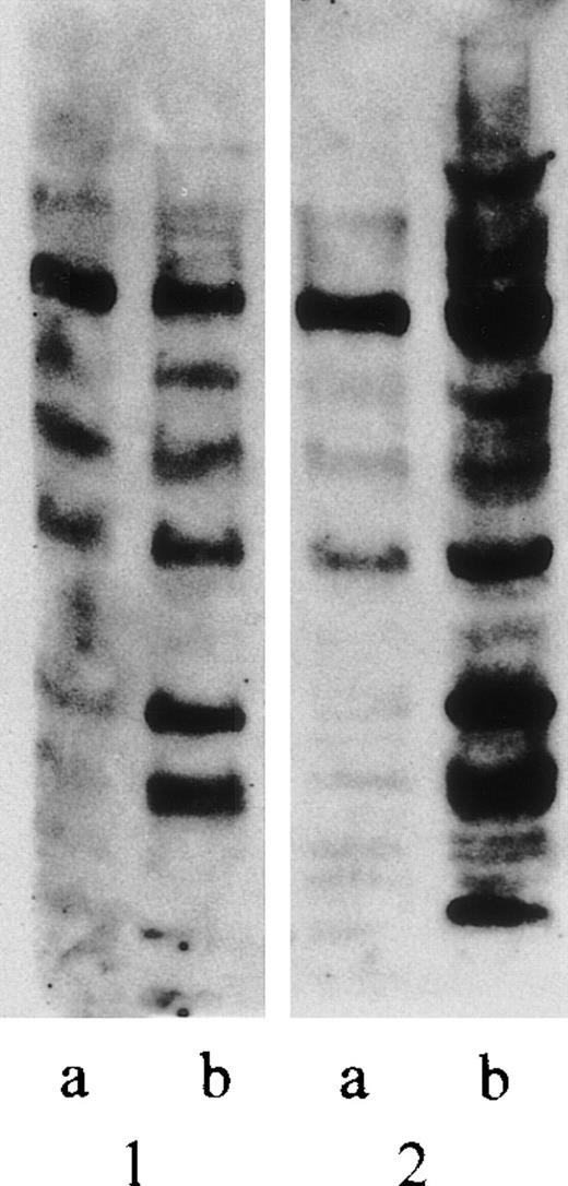 Fig. 3. High levels of ubiquitinated nuclear proteins in B-CLL. / Cytoplasmic (A) or nuclear (B) ubiquitin-conjugated proteins of untreated PBL (lane 1) or untreated B-CLL cells (lane 2) were determined by Western blot in 10% SDS-PAGE. An equal amount of protein derived from 1.5 × 106 cells was deposited in each lane. The results represent analyses of cells from 10 different patients and 10 different normal donors.