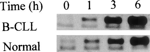 Fig. 5. p53 accumulation in both B-CLL and normal lymphocytes after MG132. / Western blot analyses of the nuclear wild-type p53 at different times after MG132 (1 μmol/L) treatment of PBL or B-CLL cells versus untreated cells (time 0). An equal amount of protein (derived from 1.5 × 106 cells) was deposited in each lane. The same accumulation was obtained with LLnL (25 μmol/L) in both cell types. The results represent analyses of cells from 10 different patients and 10 different normal donors.