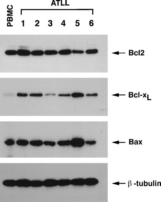 Fig. 5. Overexpression of Bcl-XL in uncultured acute T-cell lymphocytes from ATLL patients. / Lymphocytes from uninfected donors and ATLL patients were isolated by Ficoll-Hypaque gradient, washed, and lysed in RIPA buffer. Total proteins (50 μg) were separated on 12.5% SDS-PAGE transferred onto PVDF membranes and probed with specific antibodies for Bcl2, Bcl-XL, and Bax. Comparable protein loading in each lane was verified using an antibody specific for the housekeeping gene product β-tubulin. Results are representative of 2 independent experiments using 2 separate donors for PBMCs.