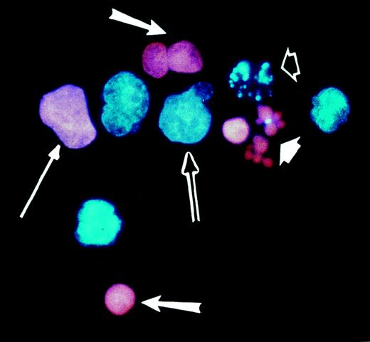 Fig. 1. Morphologies of live and dead Burkitt lymphoma cells as determined by fluorescence microscopy. / JLP 119 cells were treated with 50 μmol/L H2O2. Cells were harvested after 22 hours, stained with Hoechst 33342 and PI, and examined by fluorescence microscopy as described in “Materials and methods.” Characteristic live and dead cell morphologies are identified by the arrows as follows: double arrow, live cell; long thin arrow, necrotic cell; long fat arrows, pyknotic/necrotic cells; short white arrow, membrane-permeable apoptotic cells; short open arrow, membrane-intact apoptotic cell.