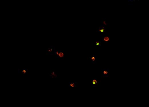 Fig. 6. Fluorescence microscopy assay for phagocytosis of Burkitt lymphoma cells by human monocyte-derived macrophages. / The phagocytosis assay was performed as described in Materials and methods. The photograph shows 3 macrophages (red-orange cells), which have engulfed VP-16–treated ST-486 (green) cells.