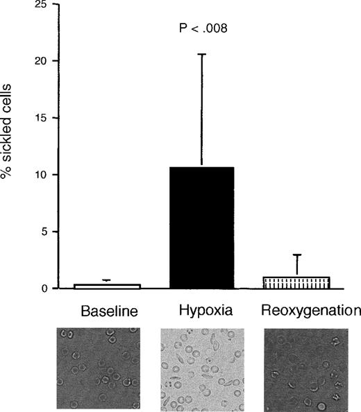 Fig. 1. Proportion of sickled cells in sickle transgenic mice before, during, and after induction of hypoxia. / The photomicrographs show representative sections of blood smears taken from a single mouse during each period. There was no significant difference between the prehypoxia and reoxygenation periods. Data shown as mean ± SD (n = 9).