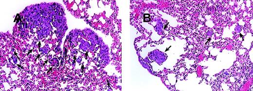Fig. 7. Blocking of MCP-1 inhibited lung tumor metastases of SCID mice bearing MDA-231 human tumor breast cancer cells. / SCID mice were injected intravenously with 20 μL of antiserum to ASGM1 on day 0, and 3 × 105 MDA231 human breast carcinoma cells were injected intravenously on day 1. Antibodies, including rabbit IgG (panel A) and 279 Ab (Panel B) at 25 μg/mouse (1 mg/kg), were given intraperitoneally to the mice on days 4, 8, 12, 16, 20, 24, and 28. For experimental metastasis experiments, mice from both groups were sacrificed on the 35th day after intravenous injection of the tumor cells. Lungs were extracted and fixed in formalin. Histological sections were stained with hematoxylin and eosin to evaluate tumor metastases. Photographs were taken at 150× magnification. The arrows indicate metastatic lesions. One representative field from 2 experiments is shown.
