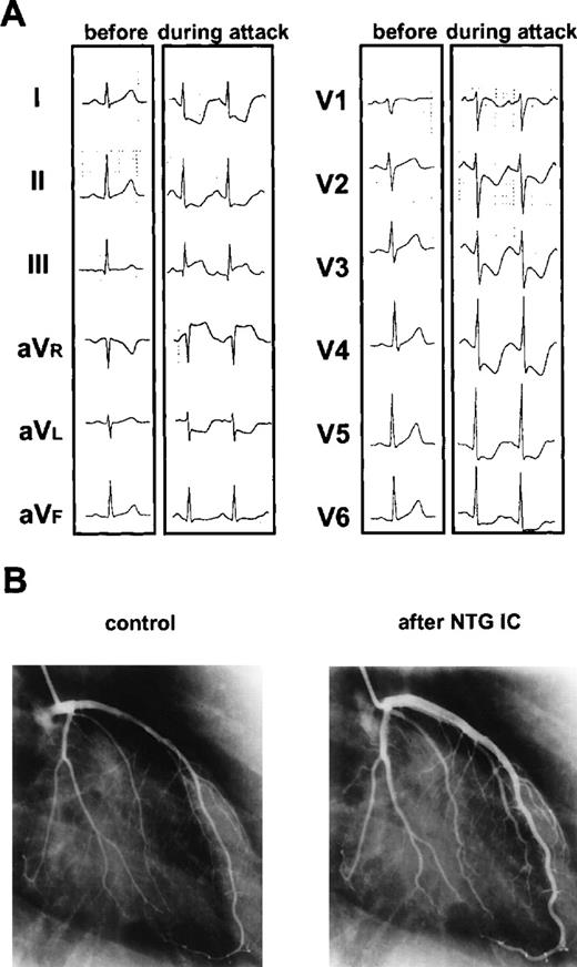 Fig. 2. Ischemic changes on electrocardiography and on diameter of coronary artery. / (A) Ischemic changes on electrocardiography before and during angina attack. During the attack, ST level was depressed significantly in the chest leads from V2 to V6. (B) Changes of diameter of coronary artery before and after intracoronary injection (IC) of isosorbide dinitrate (NTG). Coronary arteries were spastic without any significant organic lesions and widened more than twice the width of controls shortly after intracoronary injection of isosorbide dinitrate.