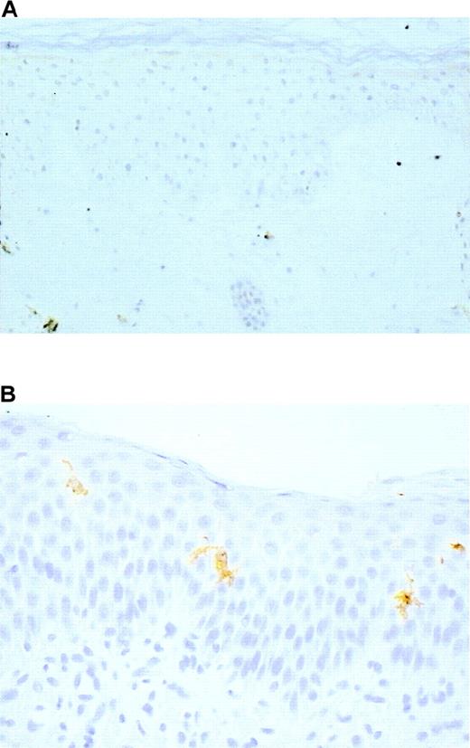 Fig. 2. Immunohistochemical detection of Langerhans cells in the epidermis of patients with reticular dysgenesis. / Langerhans cells were absent before bone marrow transplantation (A), S100 protein, original magnification ×100, but they were present after allogeneic bone marrow engraftment (B). CD1a, original magnification, ×400.