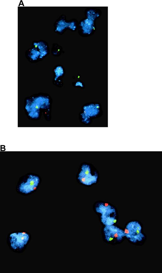 Fig. 3. Dual color FISH with probes for chromosomes X (red spot) and Y (green spot) of cells from a patient with reticular dysgenesis and chimeric hematologic reconstitution. / Most purified CD14+ blood monocytes (A) and of in vitro–generated dendritic cells (B) were autologous (XY).