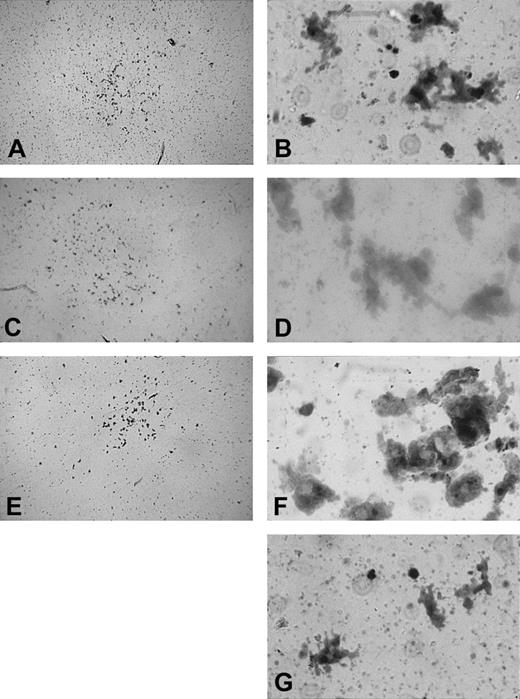 Fig. 5. Individual megakaryocytic colonies. / Photomicrographs from healthy volunteers (A, 30 ×; B, 480 ×); 2°T (C, 30 ×; D, 480 ×), and ET (E, 30 ×; F, 480 ×) patients. (G) A healthy megakaryocytic colony composed of 3 megakaryocytes (480 ×).