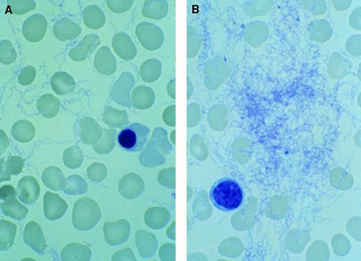 Congenital relapsing fever (Borrelia hermsii). / William A. Dittman Sr, Sacred Heart Medical Center, Spokane, WA. A 35-week infant was delivered by cesarean section because of fetal distress. Her mother presented to Sacred Heart Medical Center early because of decreased fetal movement. At delivery, the child demonstrated respiratory depression requiring intubation and manual resuscitation. Apgar scores were 1 at one minute and 5 at five minutes. The “admitting” diagnosis was sepsis with shock. Cord blood counts revealed a white blood cell count at 8.2/μL, hemoglobin level at 16.4g/dL, hematocrit level at 48.8%, and platelet count at 8/μL. Nucleated red blood cells were 88 per 100 white blood cells. During verification of the platelet count with the blood film, multiple spirochetes were seen (A), many in clumps (B). These spirochetes were further classified and confirmed by immunofluorescent antibody staining as Borrelia hermsii.  No organisms were seen on multiple blood films of the mother. Although the placenta was grossly and microscopically normal, silver stains demonstrated spirochetes.  A review of the prenatal history identified an episode of fever, chills, aching, headache, and fatigue which occurred at week 16 of the pregnancy. The mother recalled a similar one-day illness at week 19. There were no other untoward events until presentation.  The child was treated with fluids for the septic shock. Ampicillin and cefotaxime were given initially, and erythromycin was added when the spirochetes were found. Dexamethasone was administered for the septic shock and thrombocytopenia. Improvement was progressive until day 9 when hypotension, pallor, and abdominal distension occurred. Autopsy revealed bleeding into a liver abscess with subsequent rupture of a subcapsular hematoma. No organisms were found in the abscesses at autopsy.  Relapsing fever (tick-borne borrelia hermsii) is endemic to the western United States. It is transmitted by theOrnithodoros hermsii tick.