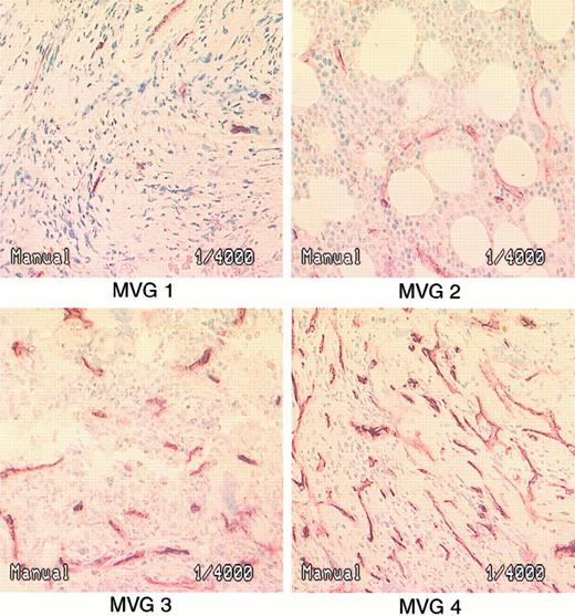 Fig. 1. Visual microvessel grades of bone marrow angiogenesis in patients with myelofibrosis with myeloid metaplasia. / MVG 1, normal or slightly increased MVD; MVG 2, microvessels are easy to find and are definitely increased from normal; MVG 3, abundant microvessels; MVG 4, markedly increased MVD.