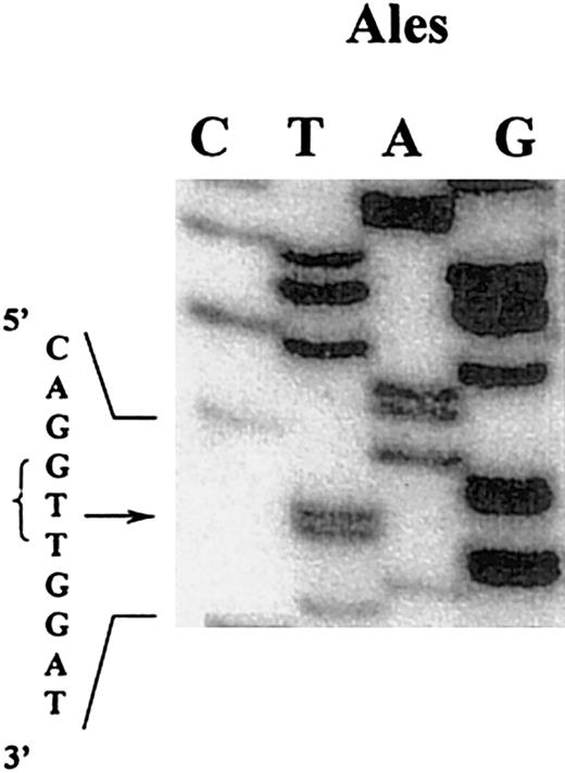 Fig. 7. DNA sequence analysis of a mixture of clones containing the amplified exon VIII of the γ-chain gene coding for fibrinogen Alès. / An adenine was substituted by a thymine (arrow indicates the mutation), changing the triplet GAT (Asp) to GTT (Val).