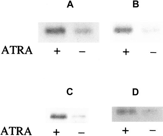 Fig. 2. ATRA induction of FR-β in AML blasts from patient marrow. / Cells (1 × 106) were cultured and treated with or without ATRA (1 μmol/L) for 6 hours (panels A and B), 24 hours (panel C), or 5 days (panel D). The samples were obtained from separate patients with FAB-M2 (panels A and C) or FAB-M4 (panels B and D) type AML. Cell lysates were then examined by Western blot with the use of rabbit anti–FR-β and AP-conjugated secondary antibody.