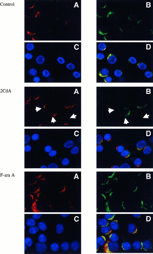 Fig. 4. Immunocytochemistry of mitochondrial damage. / B-CLL cells were treated with the indicated drugs for 8 hours. Cells were stained for mitochondria membrane potential with MT orange (red, A) for 30 minutes, pelleted on a slide at 300g, fixed in 4% paraformaldehyde, and stained for cytochrome c (green, B) with monoclonal antibody and secondary antibody Alexa 488. DNA was visualized with DAPI (blue, C). (D) Composite image. Arrows show cells affected by the drug, where cytochrome c release is noticeable. Images were obtained with a Zeiss Axioscope microscope, with CCD camera.
