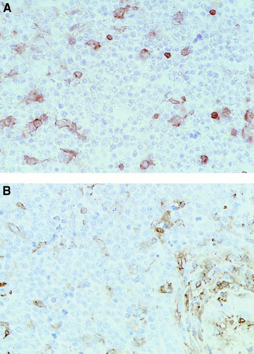 Fig. 1. Immunohistochemical analysis of representative testicular DLCL cases. / Immunohistochemical staining was performed with the use of (A) the MoAb HCA2 (anti-HLA-A) (T20) and (B) the MoAb clone B8.11.2 (HLA-DR) (T18) (original magnification × 40). Note the positive (brown) staining in the internal control cells scattered through the mass of negative lymphoma cells.
