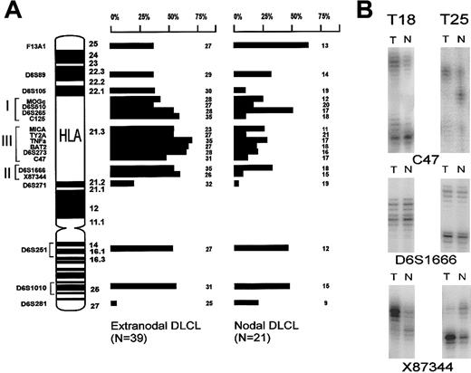Fig. 2. LOH analysis. / (A) Ideogram depicting the chromosome 6p and q arms. All microsatellite markers used for LOH analysis and their location are indicated. On the right-hand side, the LOH data of the extranodal and nodal series of DLCLs are summarized. Each bar represents the percentage of informative cases with LOH (their number depicted at the right). (B) Example of 2 testicular lymphomas (T18 and T25) that show retention of heterozygosity at marker D6S1666 near HLA-DQB1, and allelic imbalance is shown at both flanking markers C47 and X87 344. This suggests a homozygous deletion. Allelic imbalance was determined by comparing the ratio between alleles of tumor DNA (T) and normal DNA (N).