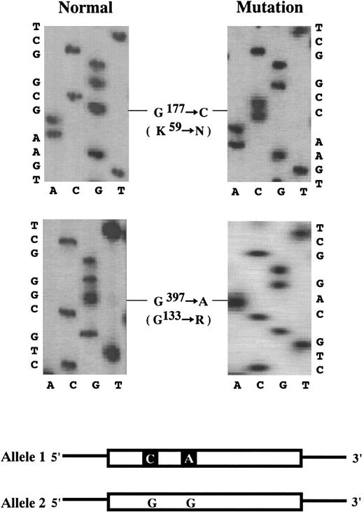 Fig. 1. Nucleotide sequence analysis of ALAD cDNA from the proband. / G177 to C transition, producing K59N substitution, and G397 to A transition, producing G133R substitution. Scheme: Schematic representation of the proband's ALAD cDNA. Allele 1 has 2 base transitions, G177 to C and G397 to A, while Allele 2 is entirely normal. Thick boxes and thin horizontal lines denote translated and untranslated regions, respectively.