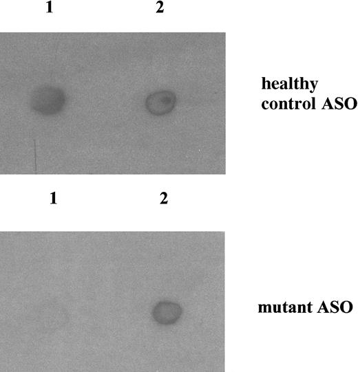Fig. 3. ASO analysis of genomic DNA. / Amplicons from exon 5 of genomic DNA prepared from mononuclear cells of a healthy subject and EBV-lymphoblastoid cells from the proband were spotted onto a sheet of nylon filter and hybridized with the normal or the mutant nucleotide as described in “Materials and methods.” Top panel, with the normal oligonucleotide; bottom panel, with the mutant oligonucleotide. Lane 1, healthy subject; lane 2, the patient.