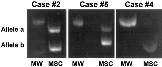Fig. 1. Representative results of stromal cell analysis by PCR-based HUMARA analysis. / Marrow stromal cells from 3 male patients (case nos. 2, 4, and 5) allografted into female donors were generated in vitro, extensively depleted of monocyte-macrophages, and analyzed by PCR for the presence of donor-derived mesenchymal cells. In case nos. 2 and 5, 2 HUMARA alleles were detected by PCR amplification, thus demonstrating the partial female origin of stromal cells, whereas in case no. 4 only one allele was detected, thus demonstrating the host origin of stromal cells. MW indicates molecular weight marker; MSC, marrow stromal cells.